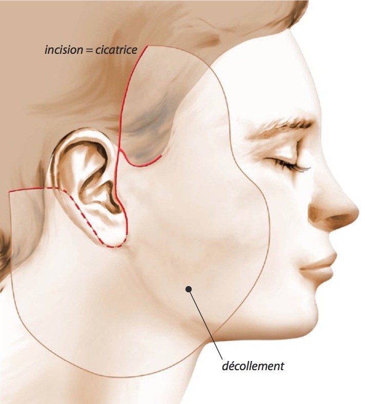 Insisions lifting facial