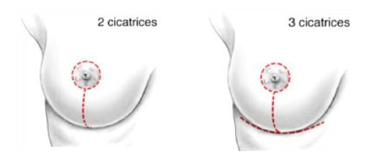 lifting seins avec reduction mammaire tunisie