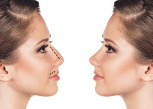 RHINOPLASTIE