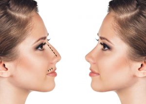 RHINOPLASTIE