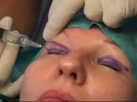 blepharoplastie-laser-tunisie