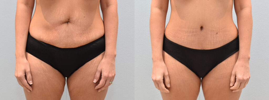 Résultat Abdominoplastie